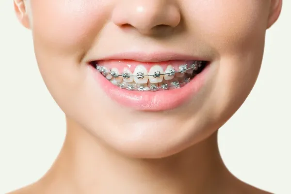 Ưu nhược điểm của mắc cài kim loại thường và tự buộc