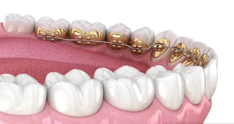 Niềng răng mặt trong là gì? Ưu nhược điểm? Chi phí và lưu ý
