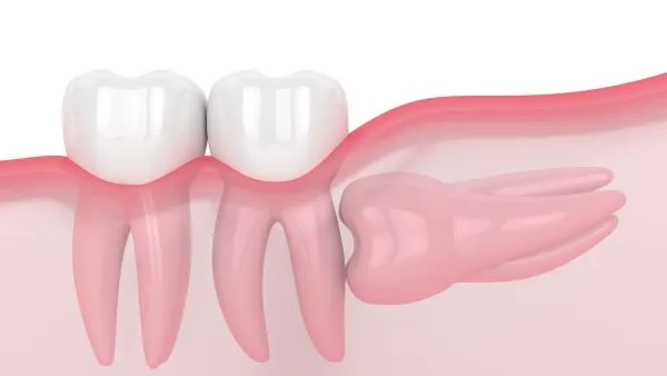 Răng khôn mọc ngầm: Dấu hiệu nhận biết sớm và điều trị