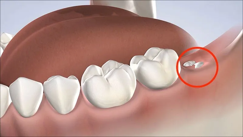 Triệu chứng mọc răng khôn điển hình và lưu ý nên biết