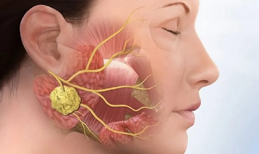 Bị đau quai hàm gần tai bên phải: Nguyên nhân và cách xử lý 5 Bị đau quai hàm gần tai bên phải