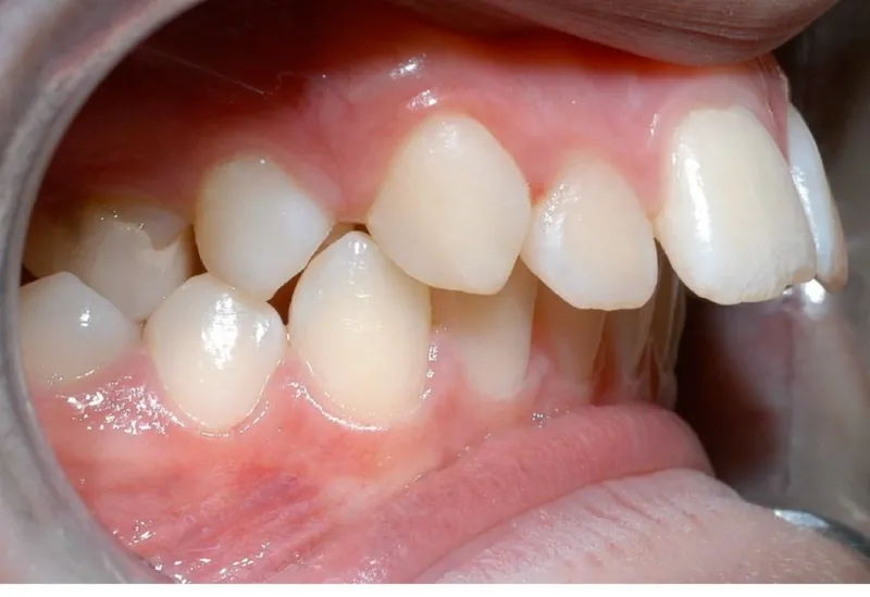 Các loại răng vẩu thường gặp