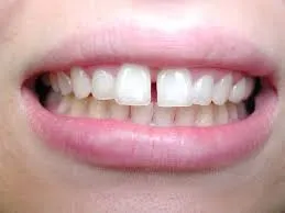 Cách khắc phục tình trạng răng cửa thưa