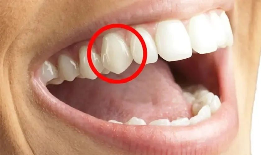 Chức năng của răng nanh là gì