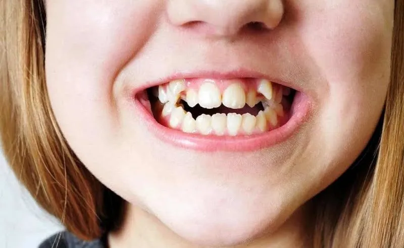 Đặc điểm cơ bản của răng nanh