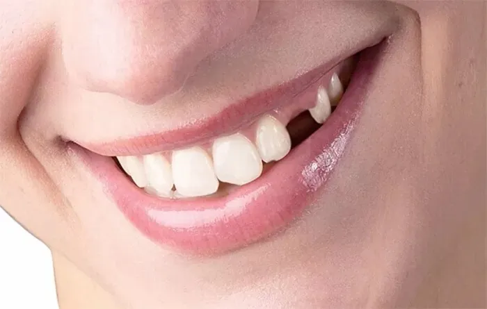 Giải pháp nào cho răng cửa mọc lệch