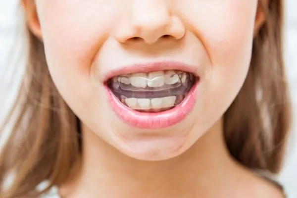 Hàm trainer là gì? Có tốt không? Phân loại và giá bán 8 Hướng dẫn đeo Hàm Trainer đúng cách