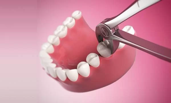 Khi nào nên nhổ bỏ răng số 7