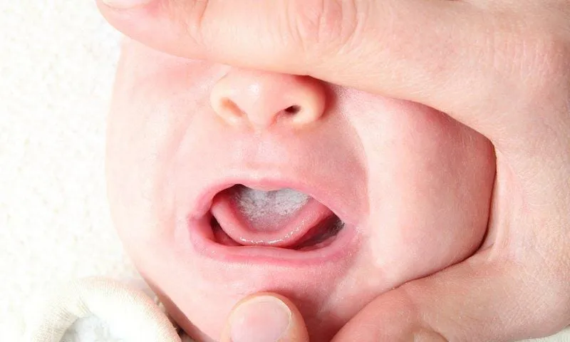 hình ảnh trẻ bị nấm miệng