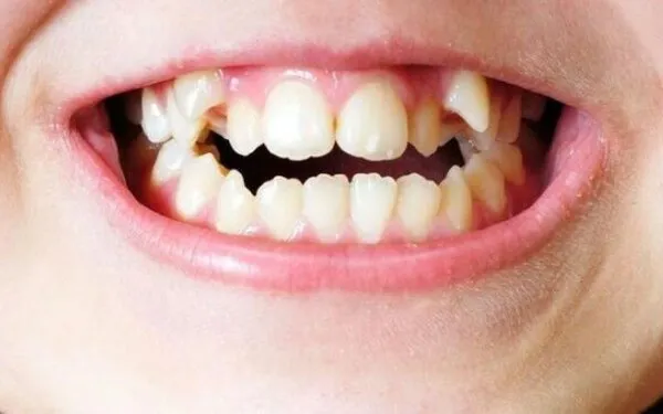 Tính cách và vận mệnh của người có răng chó