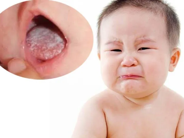 Triệu chứng nấm miệng ở trẻ sơ sinh