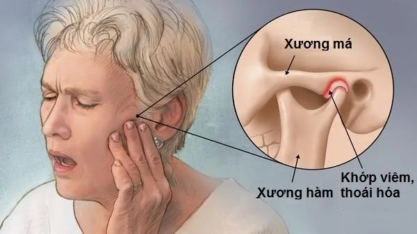Rối loạn khớp thái dương hàm là gì? Nguyên nhân, cách xử lý 5 Triệu chứng rối loạn khớp thái dương hàm