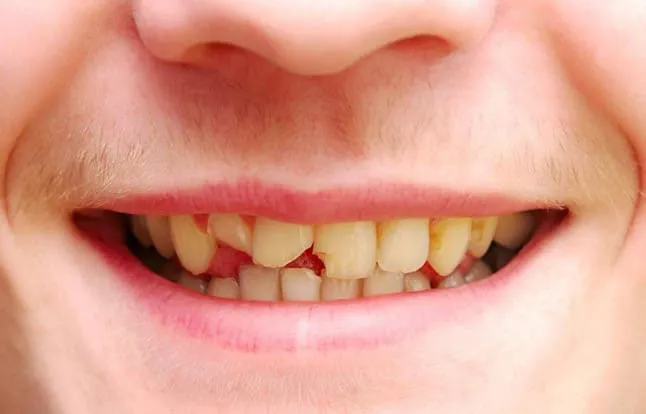 Mẻ răng có sao không? Nguyên nhân và cách khắc phục 7 Trường hợp mẻ răng phổ biến
