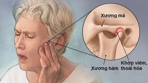 Bị đau quai hàm gần tai bên trái là dấu hiệu bệnh gì?