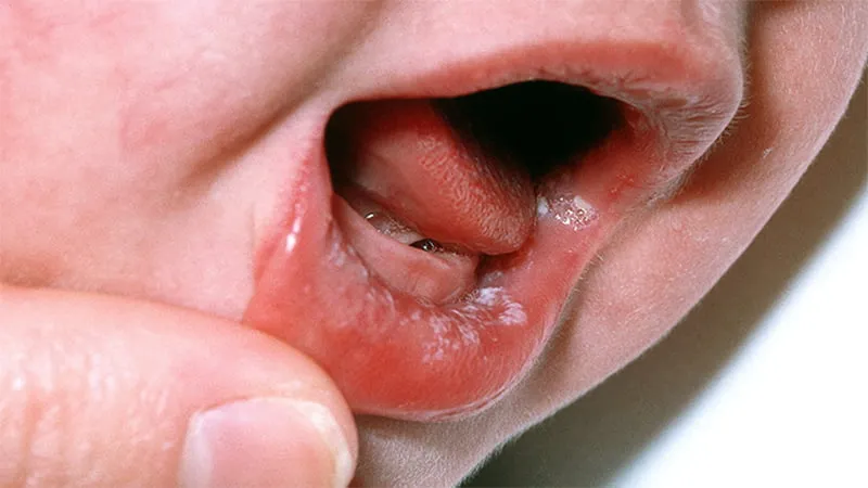 hình ảnh trẻ bị nấm miệng