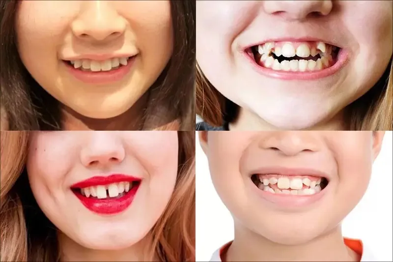 Răng chó ở người là gì? Cách khắc phục răng chó hiệu quả