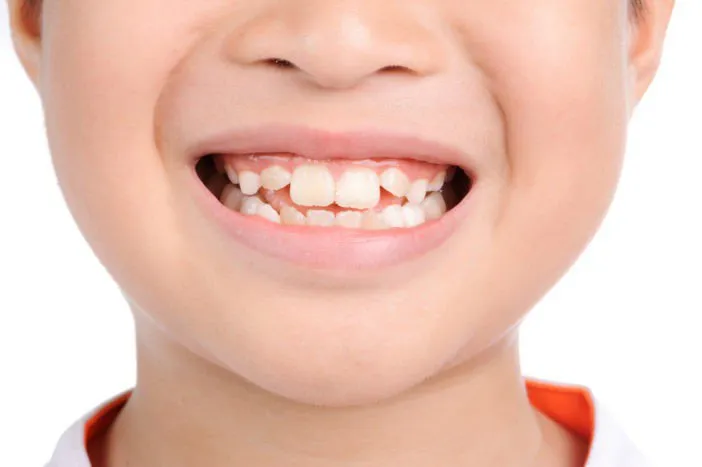 Răng cửa mọc lệch phải làm sao? Nguyên nhân và giải pháp
