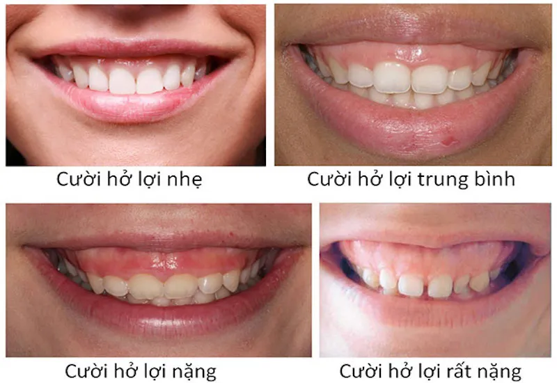 Cười hở lợi