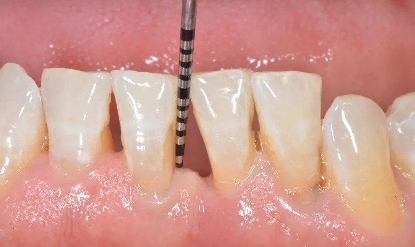 Hở chân răng là tình trạng gì? Nguyên nhân và cách chữa 5 Hở chân răng