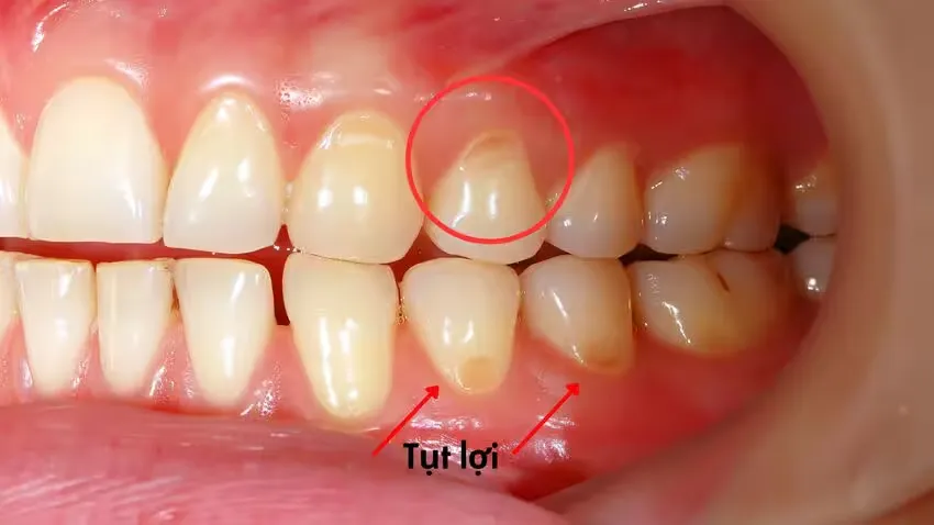 Hở chân răng là tình trạng gì? Nguyên nhân và cách chữa 6 Nguyên nhân của tình trạng tụt lợi hở chân răng