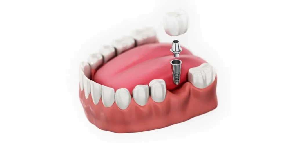Trồng răng cấm giá bao nhiêu? Nên lựa chọn phương pháp nào 8 Trồng răng cấm bằng phương pháp Implant