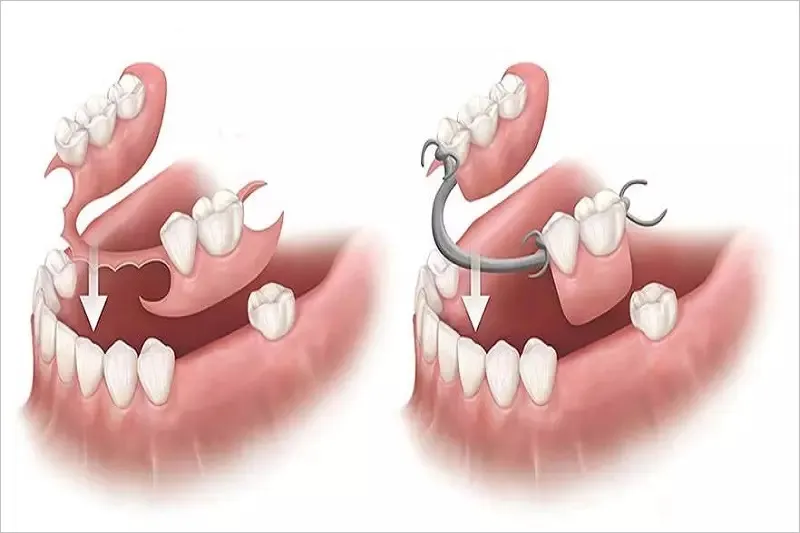 Trồng răng cấm giá bao nhiêu? Nên lựa chọn phương pháp nào 10 Trồng răng cấm bằng phương pháp hàm tháo lắp