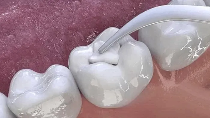 Chi phí trám răng bao nhiêu tiền? Bao lâu phải làm lại?