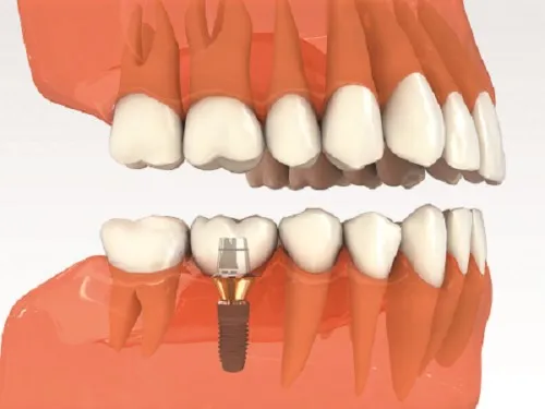 Trồng răng cấm giá bao nhiêu? Nên lựa chọn phương pháp nào