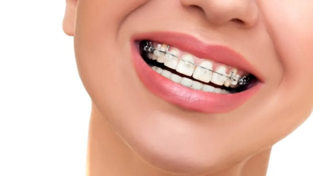 Các trường hợp được chỉ định niềng răng 1 hàm