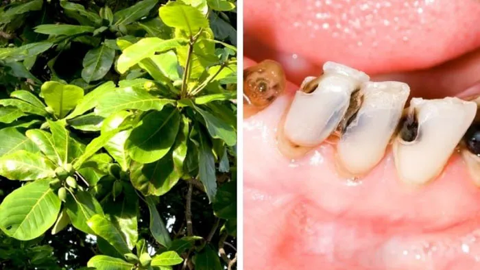 Cách chữa sâu răng tại nhà bằng lá bàng