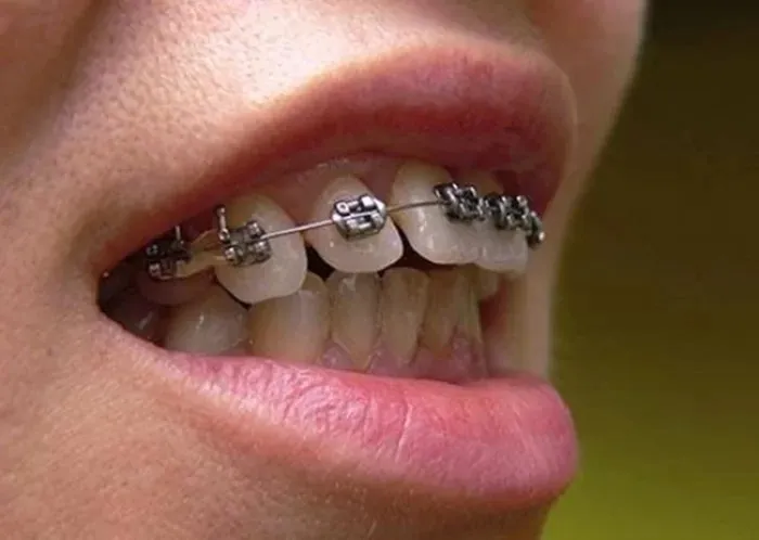 Cần lưu ý những gì khi niềng răng 1 hàm