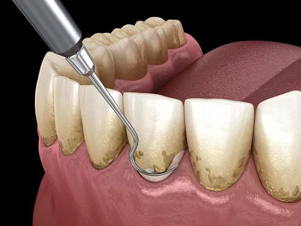 Cạo vôi răng và tẩy trắng răng là gì