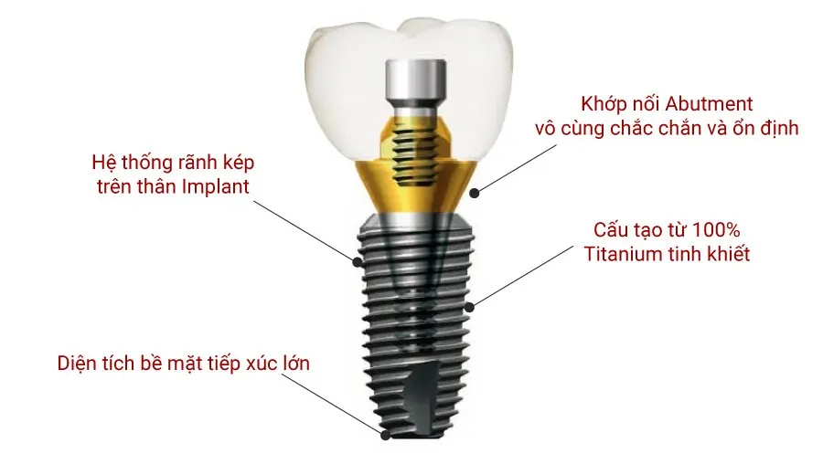 Điểm nổi bật của trụ Implant Hàn Quốc