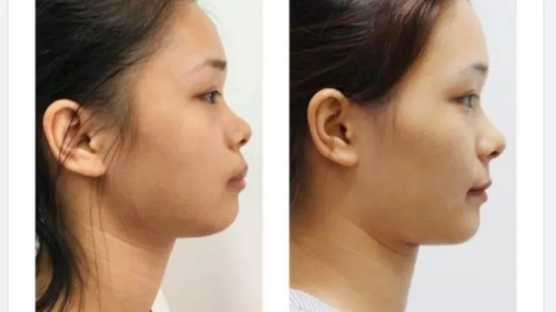 Góc nghiêng trước và sau khi niềng răng hô