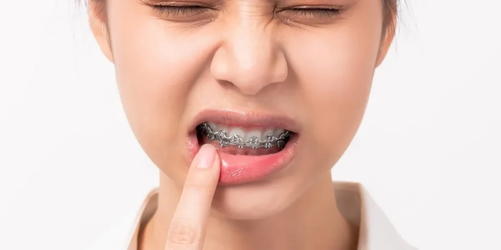Hạn chế của việc niềng răng 1 hàm