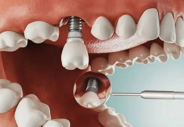 Khi nào thì nên trồng răng Implant