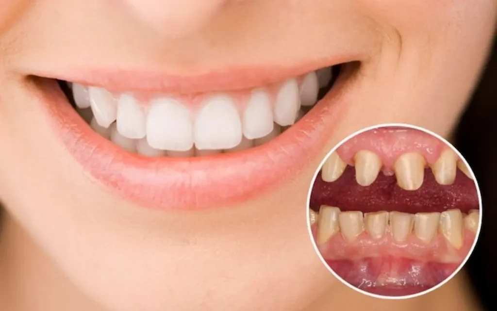 Một số lưu ý trước và sau khi mài răng lắp răng sứ