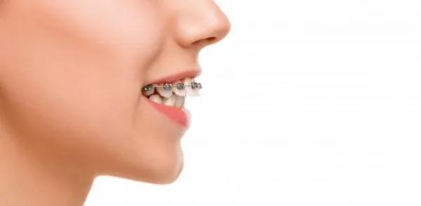 Niềng răng 1 hàm có hiệu quả không
