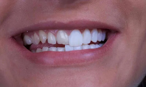 Tác hại của mài răng bọc sứ