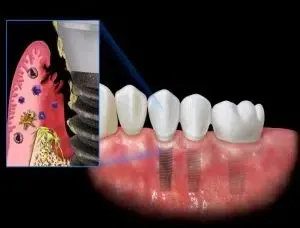 Tác hại của việc trồng răng Implant giá rẻ