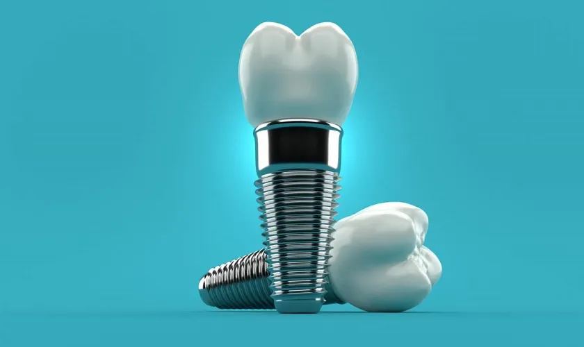 Trụ Implant là gì? Các loại trụ Implant tốt và giá 10 Tiêu chí nào chọn trụ Implant tốt nhất, phù hợp nhất