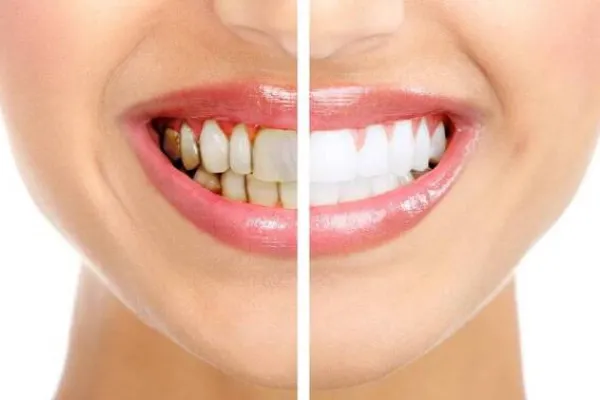Cạo vôi răng và tẩy trắng răng bao nhiêu tiền tại nha khoa