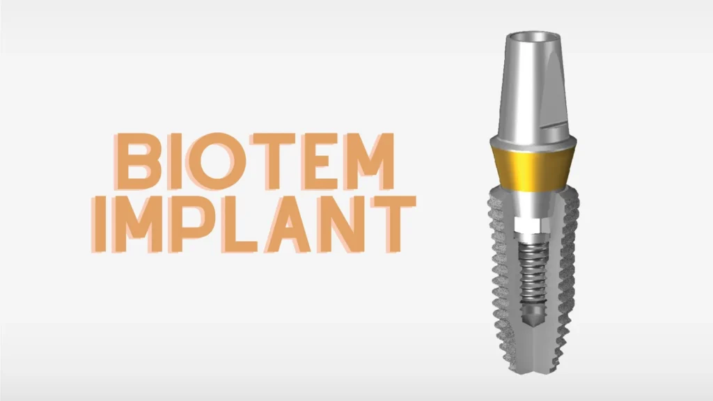 Trụ Implant Biotem có tốt không? Ưu nhược điểm và bảng giá 5 implant biotem