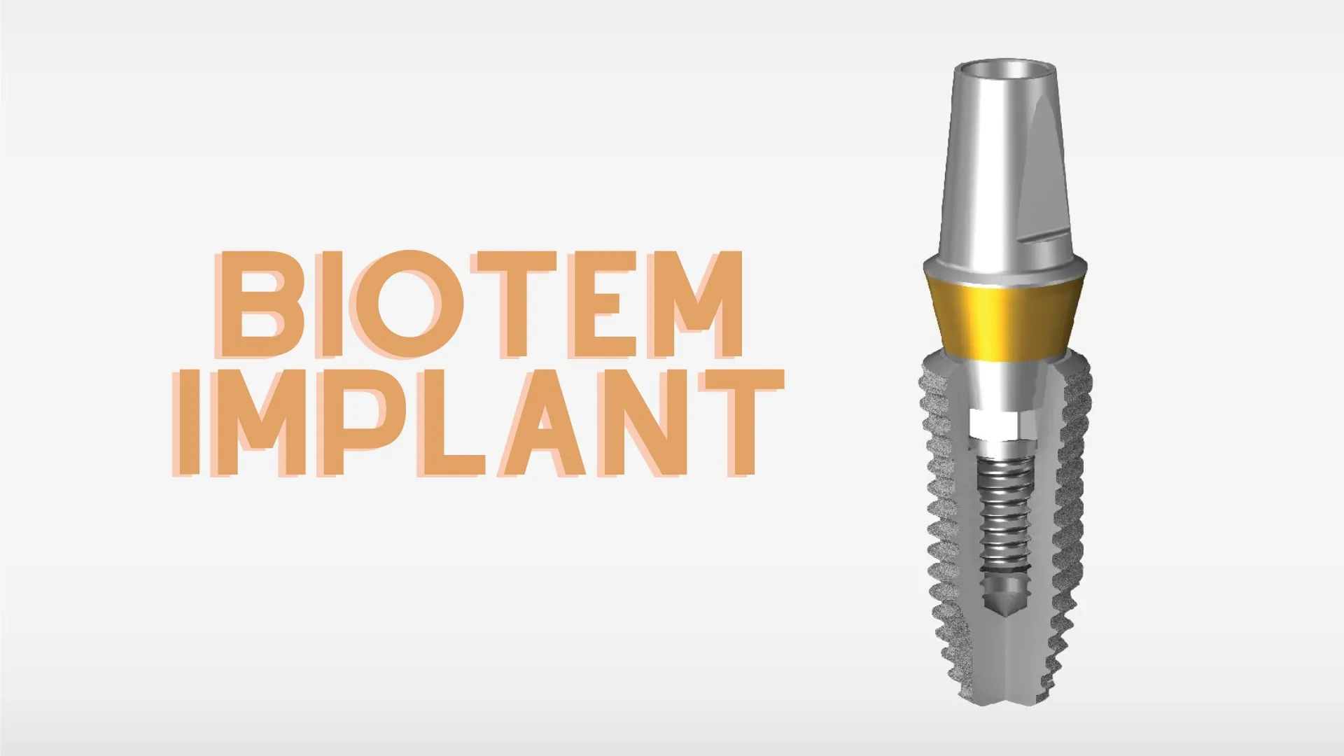 Trụ Implant Biotem có tốt không? Ưu nhược điểm và bảng giá