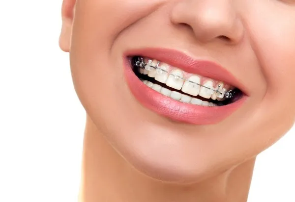 Niềng răng bao nhiêu tiền 1 hàm? Quy trình thực hiện