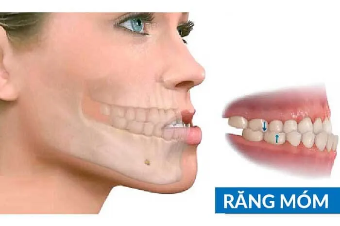 Niềng răng móm bao nhiêu tiền? Chi phí trọn gói mới nhất 6 niềng răng móm bao nhiêu tiền