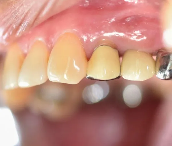 Hậu quả của tình trạng răng sứ bị hở nếu không được xử lý
