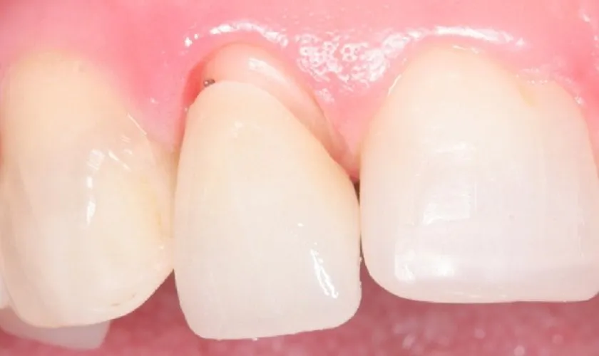 Nguyên nhân răng sứ bị hở