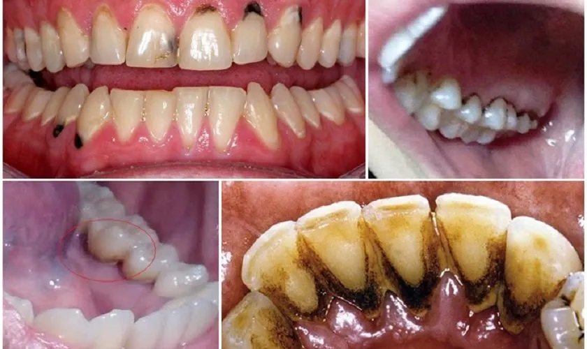 Những vị trí dễ xuất hiện vết đen trên răng