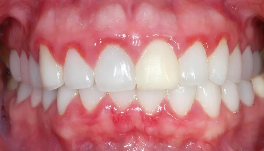 dấu hiệu răng sứ bị hở